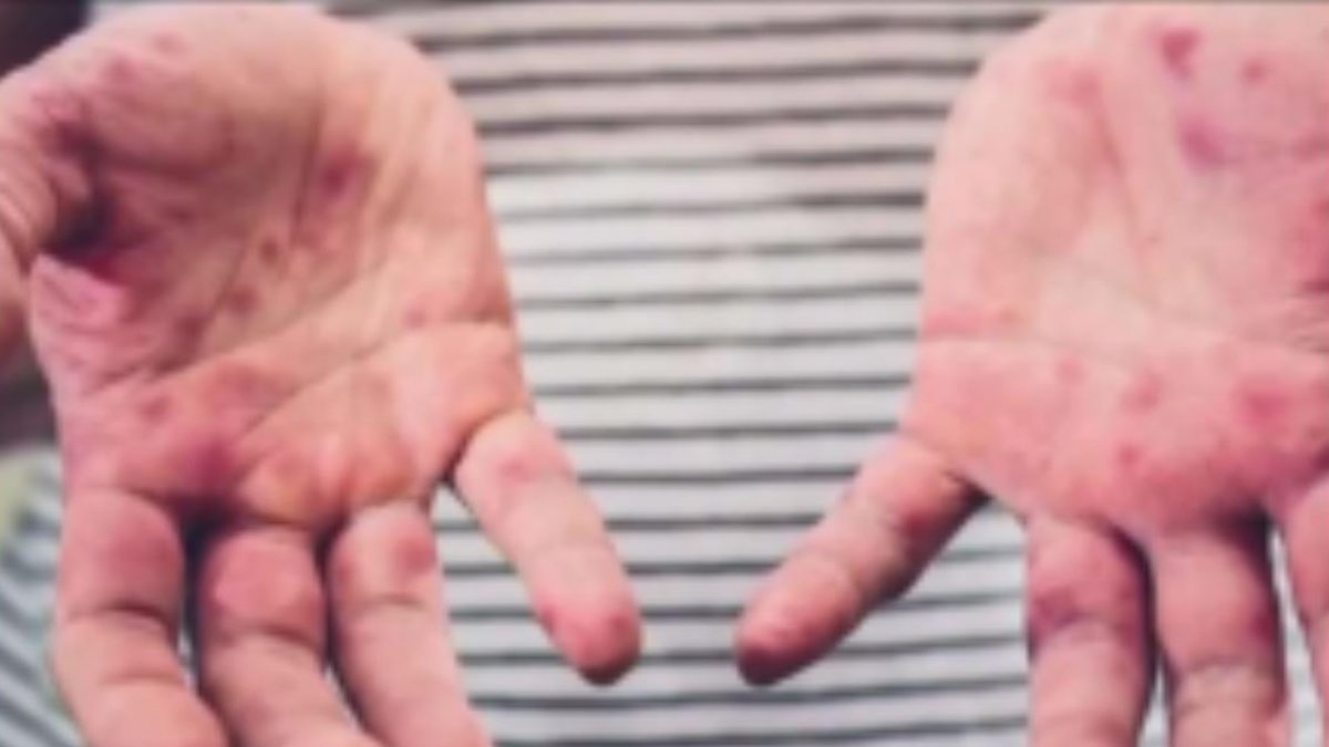 Are Measles Cases on the Rise in NYC Shelters?