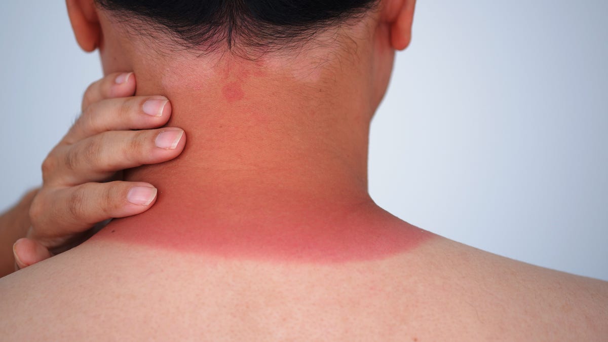 What to Put on a Sunburn?