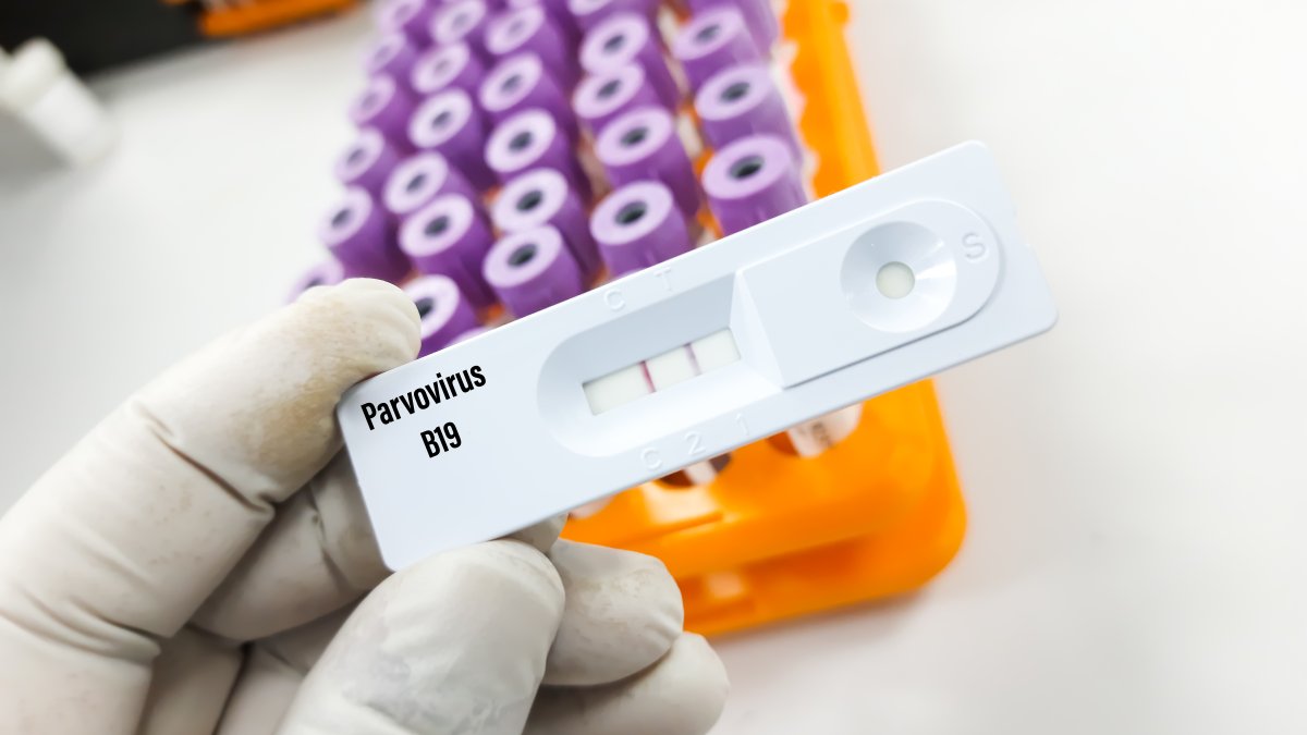 What are the symptoms of parvovirus B19?