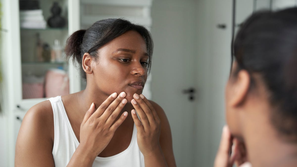 How can you effectively eliminate hormonal acne?